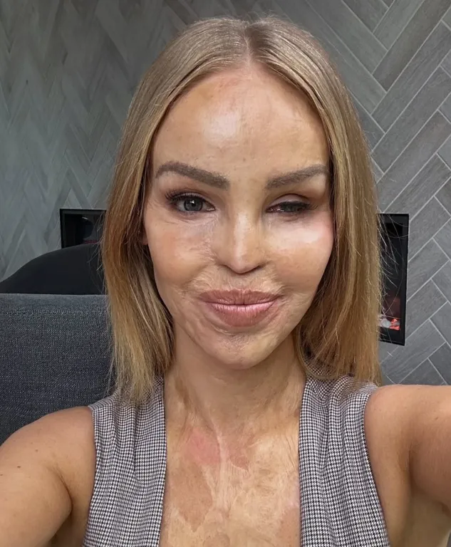 Katie Piper: A borzalmas savtámadás túlélőjének története-1