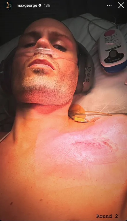 Max George újabb szívműtéten esett át – sokkoló részletek-1