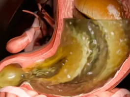 All side effects of Ozempic as simulation shows true reality of what jab does to your body