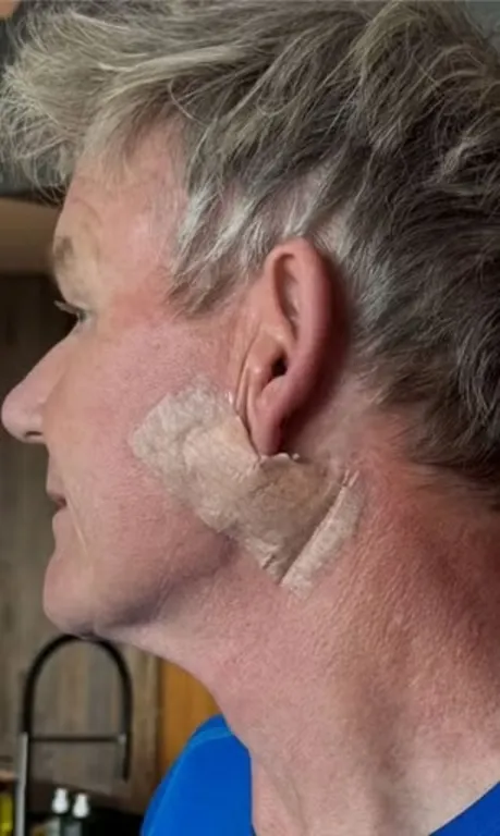 Gordon Ramsay rákos műtét: Ne feledd a napvédőt!-1