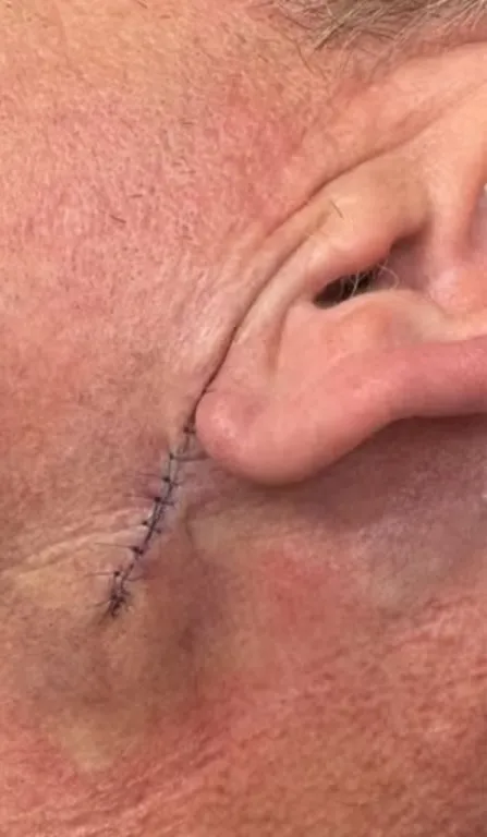 Gordon Ramsay rákos műtét: Ne feledd a napvédőt!-2