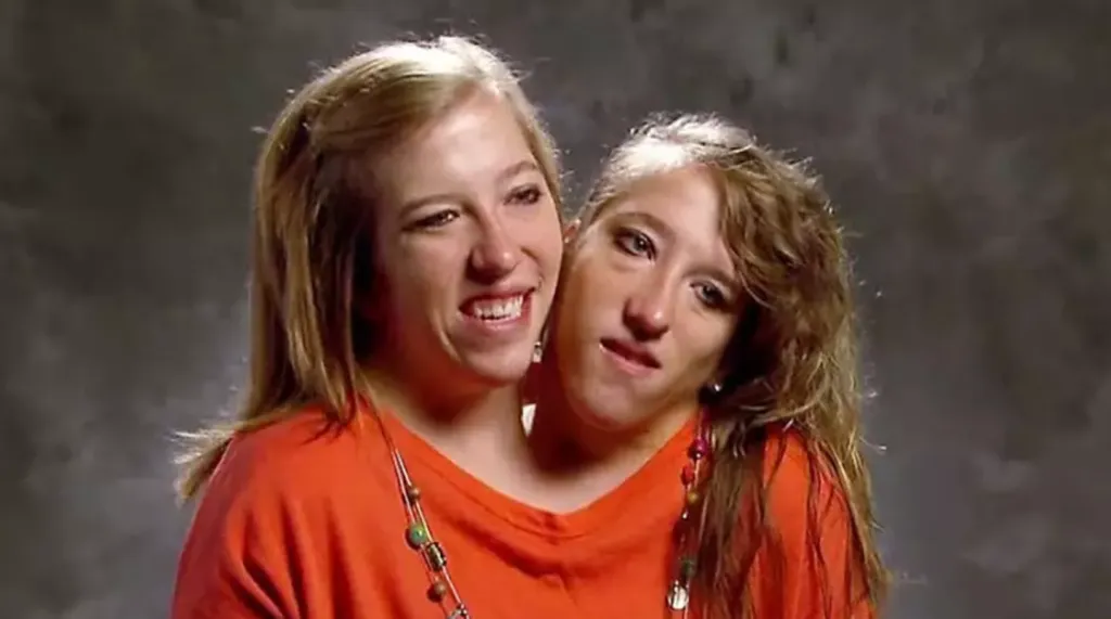 Egyesült ikrek titka: Újszülöttel látták a Hensel nővéreket!-2