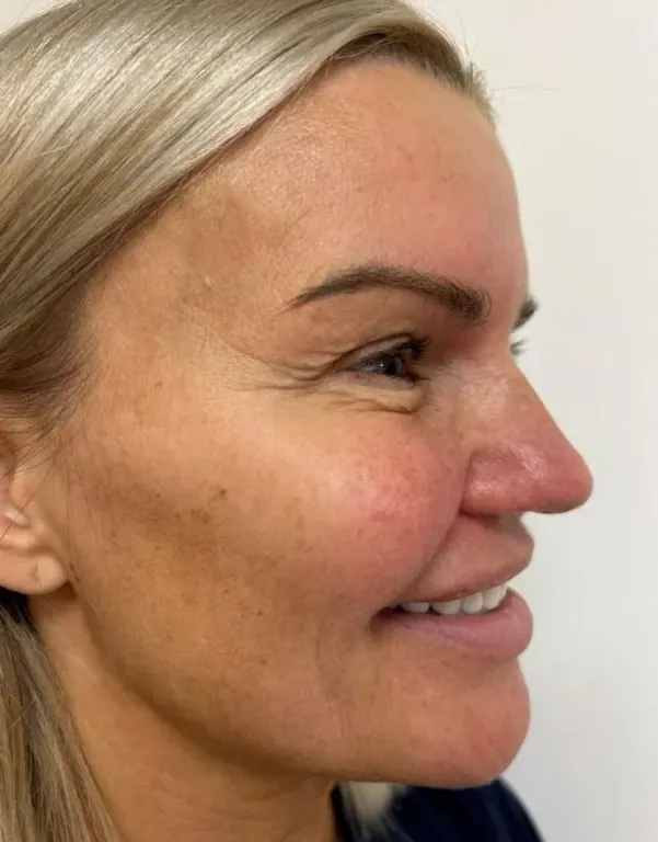 Kerry Katona nem műtteti orrát: Megható drog-ok miatt!-1