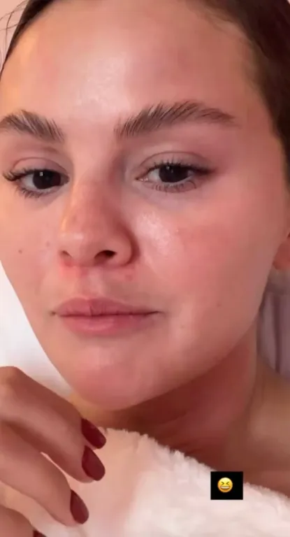 Selena Gomez felfedi: Melasma okozza ‘bajuszát’!-1