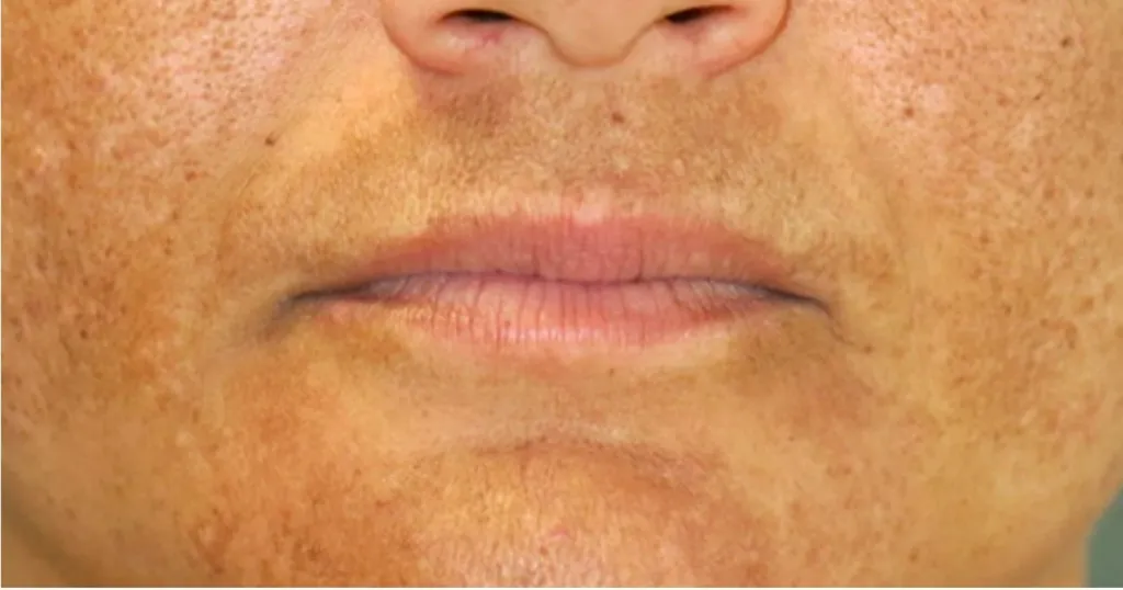 Selena Gomez felfedi: Melasma okozza ‘bajuszát’!-2