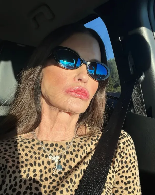 Janice Dickinson perli az ITV-t 700 ezer fontra arcdeformáció miatt!-2