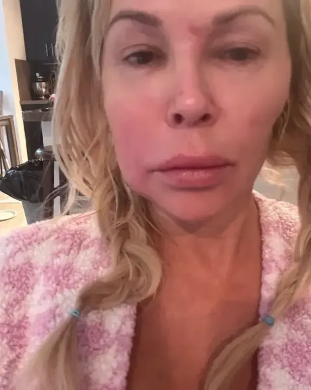 Brandi Glanville arcparazitája implantátum miatt támadt!-2